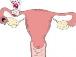 Внематочная беременность на раннем сроке: симптомы и признаки