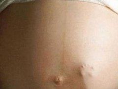 Полоска на животе во время беременности: причины и способы борьбы