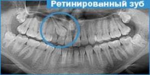 Рентген ретинированного зуба