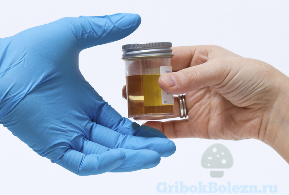 Сахар в моче при беременности: причины и последствия, симптомы, особенности лечения