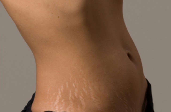 Растяжки после родов: как избавиться в домашних условиях или с помощью лазера?