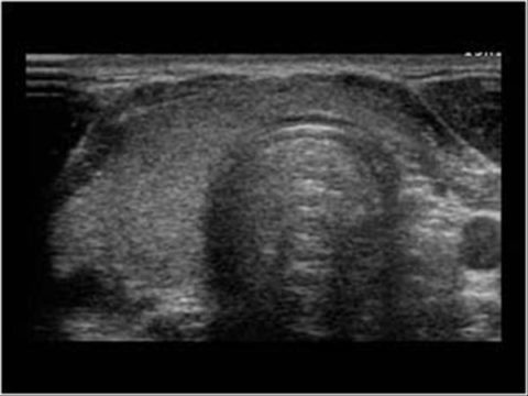 Картина гипоплазии щитовидной железы на экране аппарата УЗИ