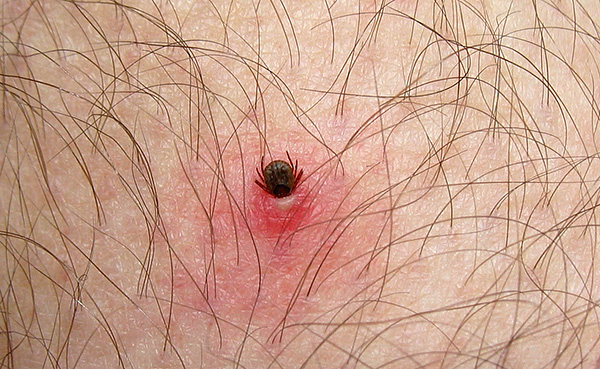 При укусе паразит может погружать свою голову в кожу на значительную глубину.