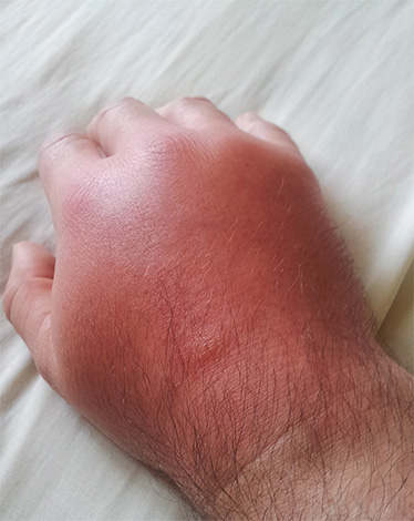Опухоль на руке после укуса шершня
