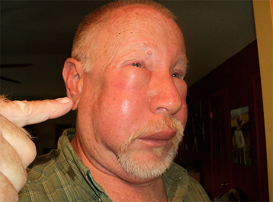 Опухоль на лице после укуса шершня