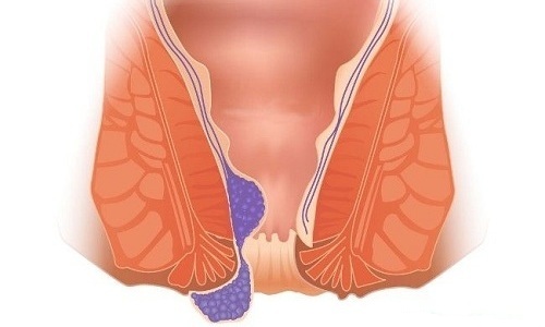 Геморрой у кормящей матери обнаруживается как непосредственно после родового процесса, так и спустя 1-2 недели