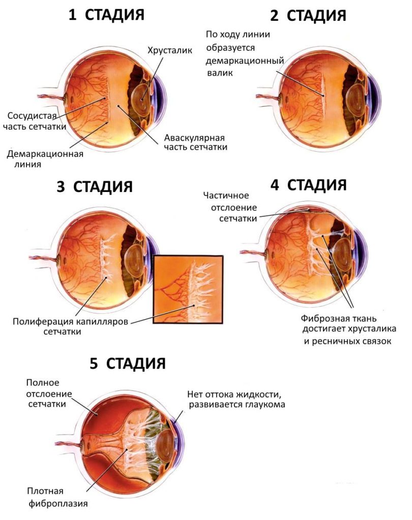 stadii-retinopatii