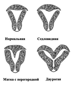 аномалии матки