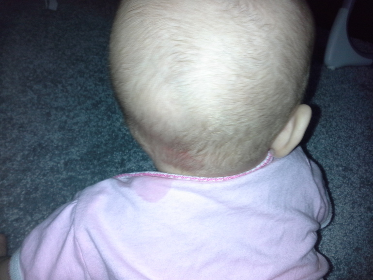 Шишка на голове у ребенка — что это может быть?