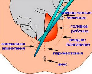 Надрезы