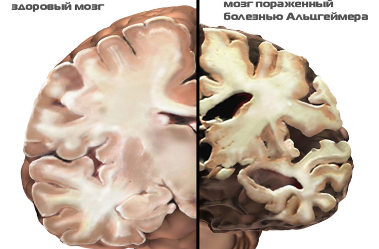 Что значит атрофические изменения. Отмирание клеток головного мозга. Мозг здоровый и Альцгеймера. Атрофические заболевания головного мозга.