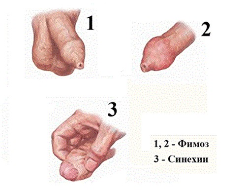 Синехии у мальчиков: фото срастания крайней плоти, лечение в домашних условиях