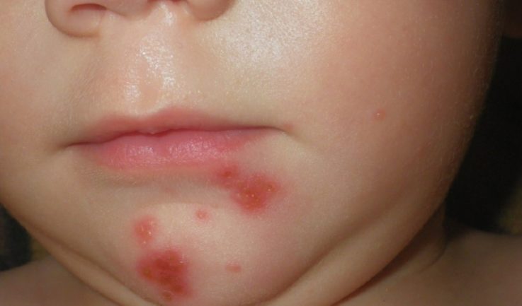 Основные особенности функции кожи у детей