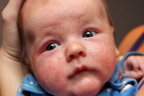 Стафилококк в носу у ребенка: лечение, симптомы и профилактика инфекции