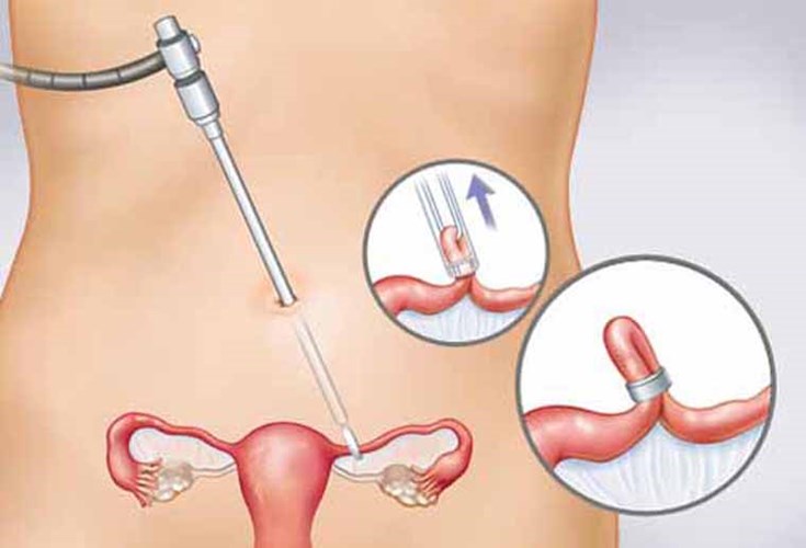 Схематическое изображение стерилизации у женщин