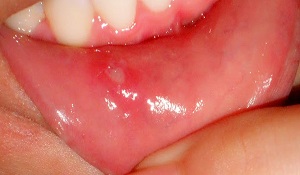 Стоматит - белые язвочки во рту