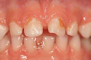 ФОТО: Бутылочный кариес зубов у ребёнка в 3 года