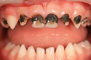 ФОТО: Серебрение молочных зубов у детей. Зубы почернели, но кариес не остановил своего развития. 