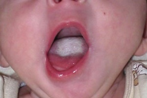 Белый налет у ребенка на языке при молочнице