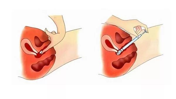 Способ применения противозачаточных вагинальных таблеток