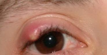 Заболевания глаз у людей: список распространенных патологий и симптомы