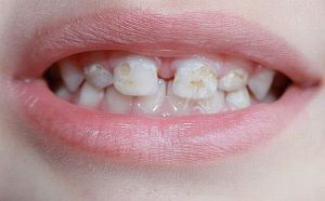 кариес молочных зубов