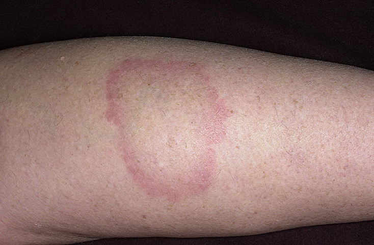 Сыпь на локтях у ребенка: фото с пояснениями, причины высыпаний на коленях