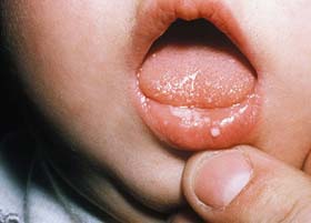 Герпетический стоматит у ребенка во рту
