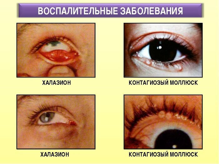 Воспалительные заболевания глаза