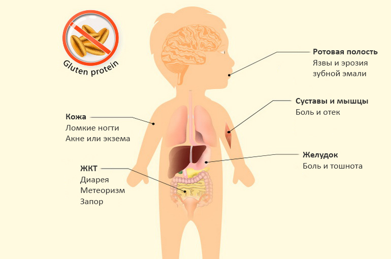 Целиакия: симптомы у детей, диагностика и лечение грудничка до года и ребенка старшего возраста