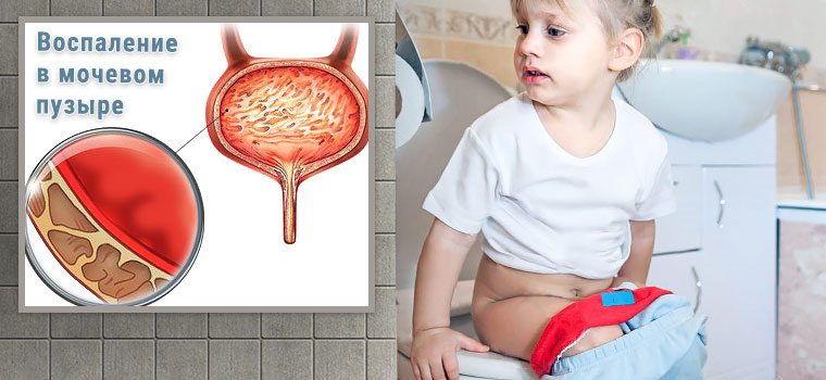 Цистит у девочек: симптомы и лечение воспаления мочевого пузыря в разном возрасте