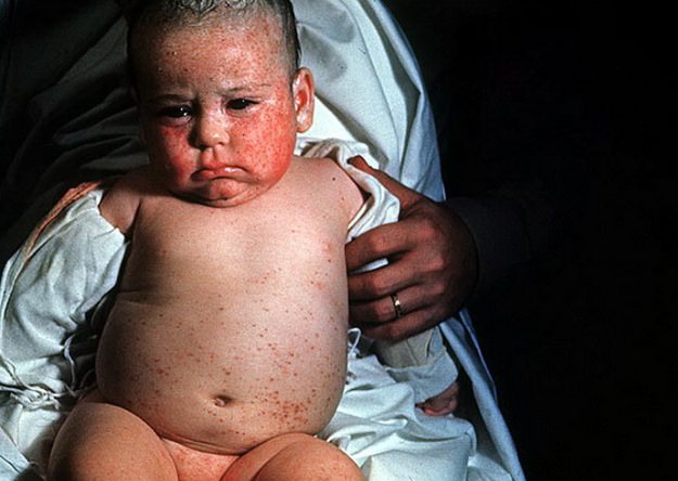 Цитомегаловирус у детей: симптомы и лечение инфекции у ребенка, последствия