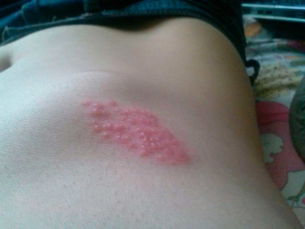 Кусали клопы