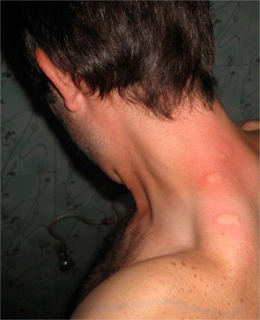 Мужчину укусил клоп