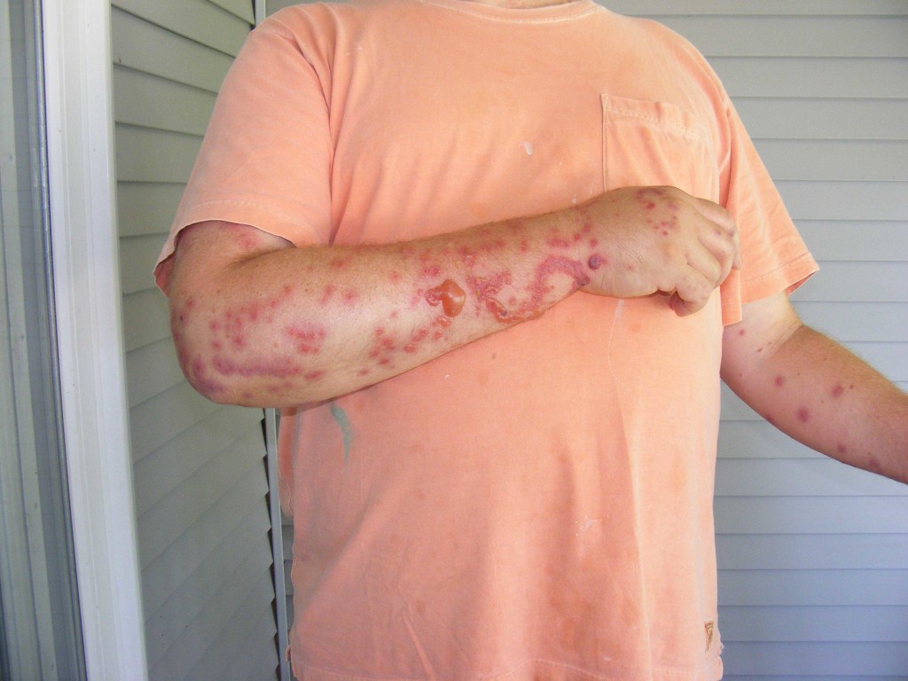 Мужчину укусили клопы