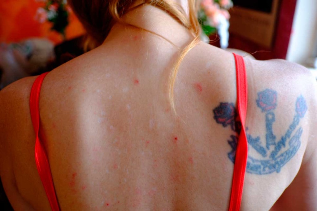 Девушке клопы покусали спину