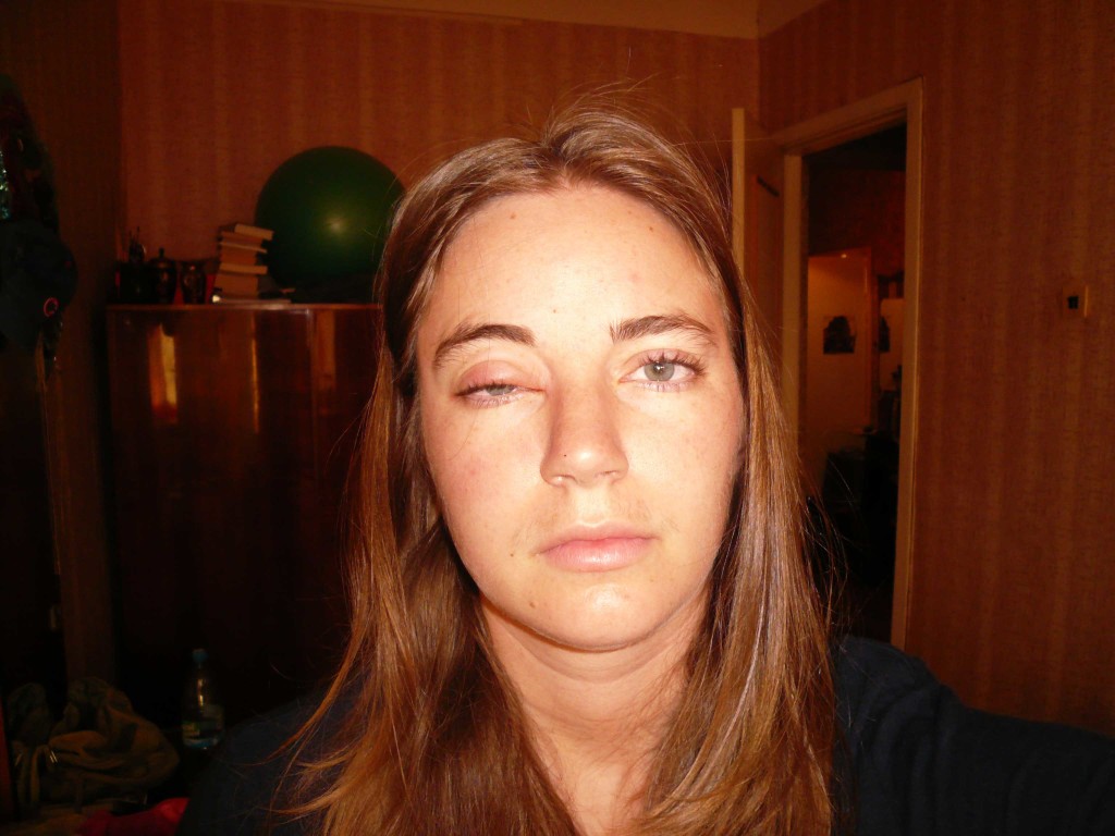 как меня покусали клопы