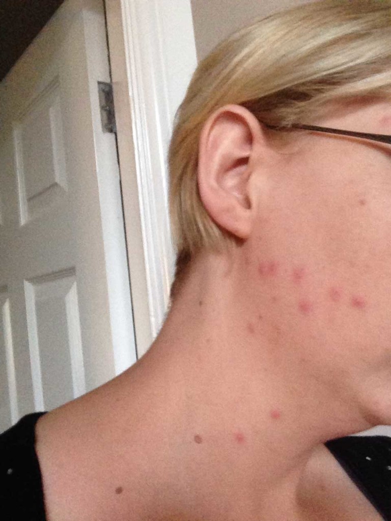 покусали лицо