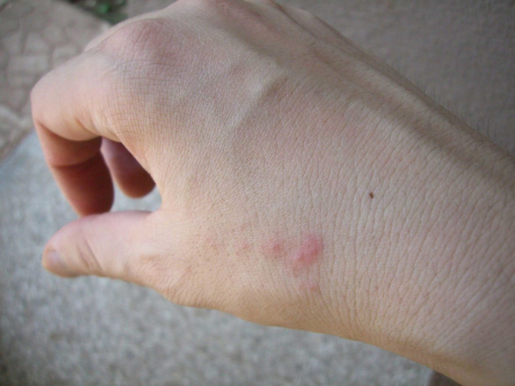 Клопы покусали руку