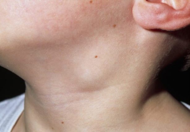 Симптомы воспаления лимфоузлов на шее
