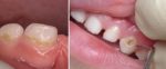 Возможен ли кариес молочных зубов?