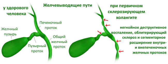 Первичный склерозирующий холангит