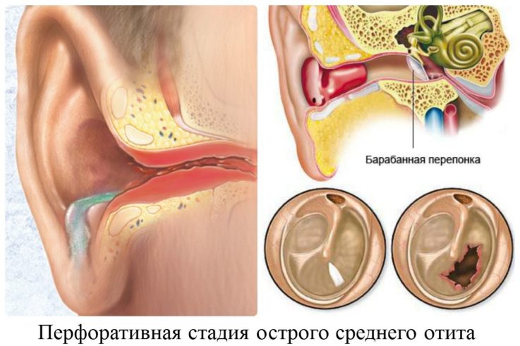 Виды отита