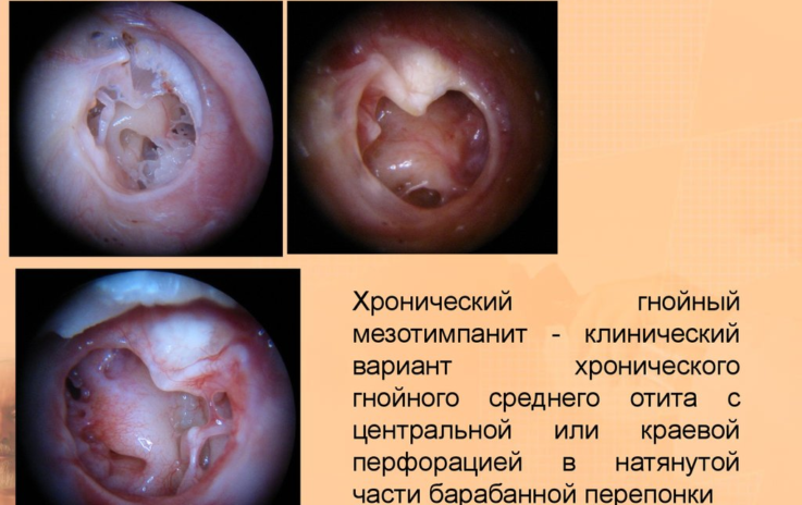 Отит среднего уха