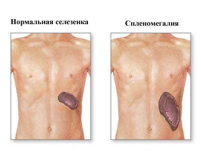 Увеличена селезенка у ребенка: причины и лечение, сопутствующие симптомы в печени