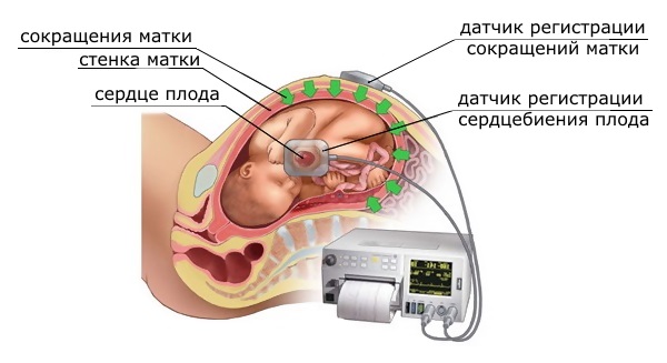 Принцип действия датчиков при кардитокографии, основанный на эффекте ультразвуковых волн