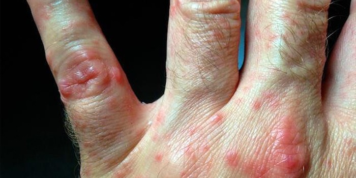 Вирус Коксаки у детей: фото, симптомы в инкубационный период, лечение