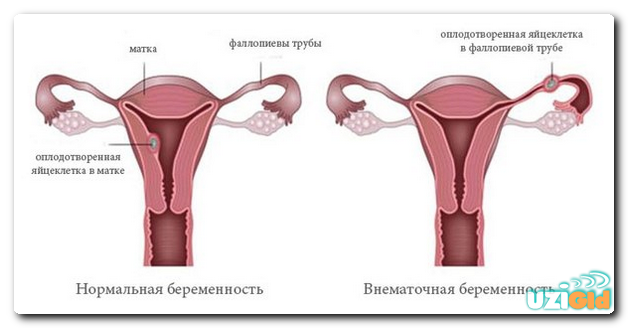 виды внематочной беременности на узи 