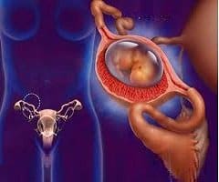 Как определить внематочную беременность на ранних сроках