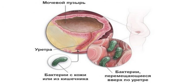 Что же такое инфекция мочевыводящих путей